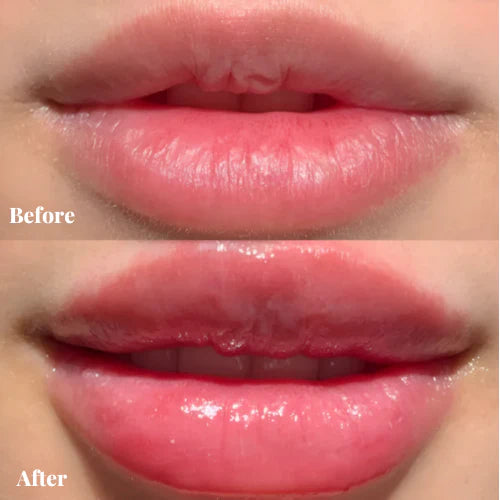 -Lip Boost Kit-